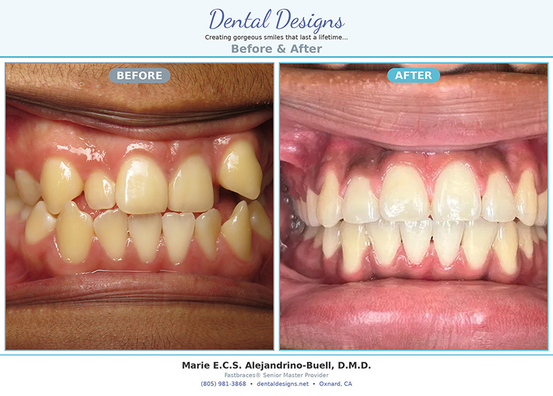 before and after