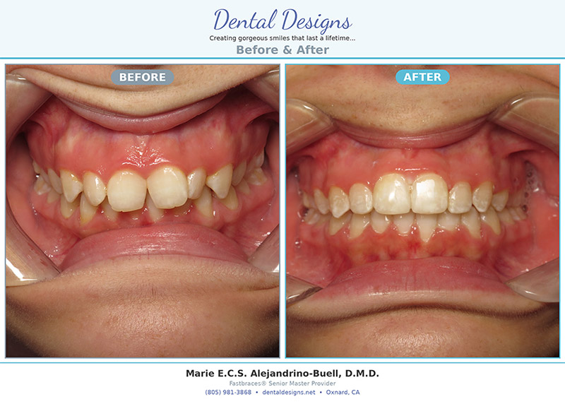 Dental treatment before and after results