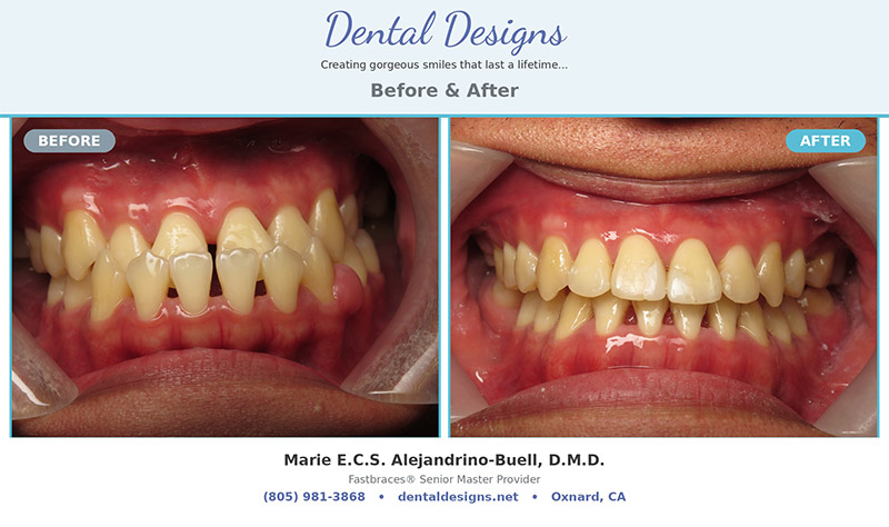 Dental treatment before and after results