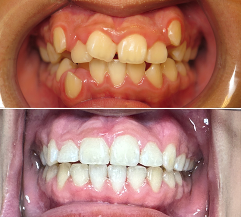 before and after