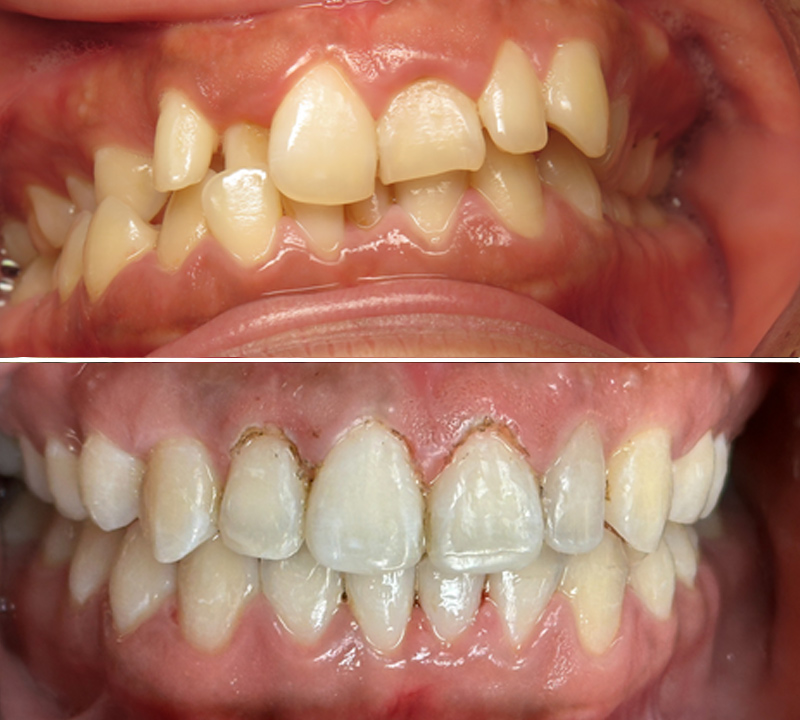 before and after
