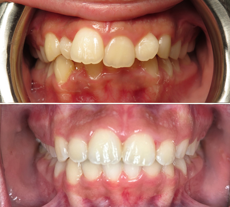 before and after